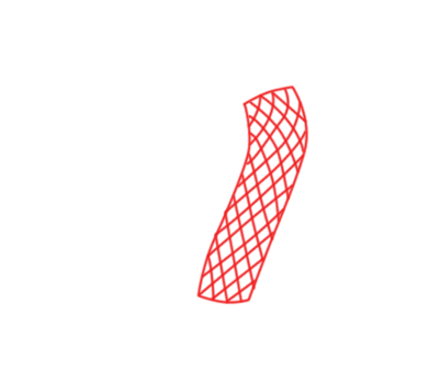 Balloon Angioplasty