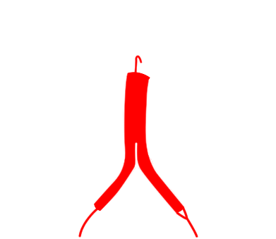 Abdominal Aortic Aneurysm Surgery