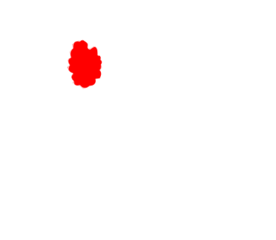 Lung Cancer
